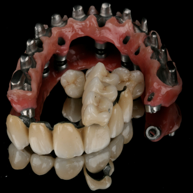 Advantages of Implant-Supported Fixed Teeth