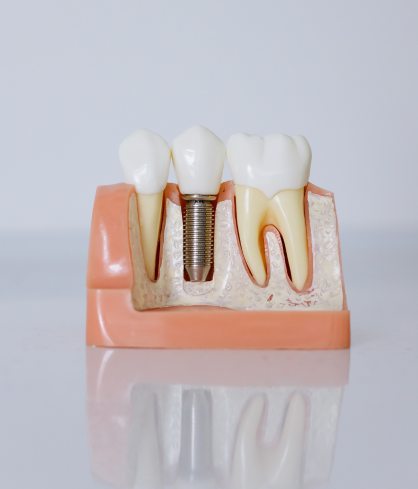 Implant-Supported Fixed Teeth