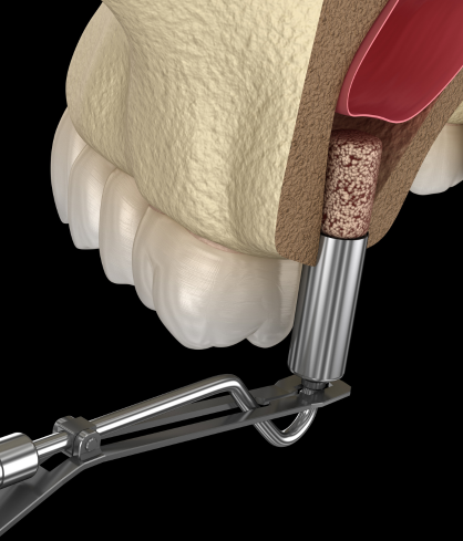 Sinus Lift Procedure