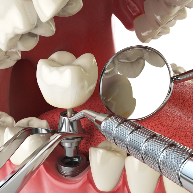 Implant-Supported Fixed Teeth(2)