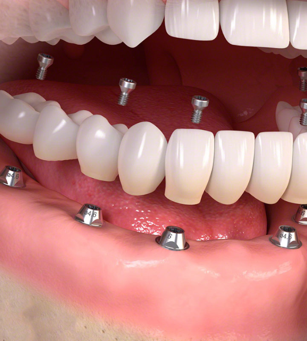 full-arch replacement)