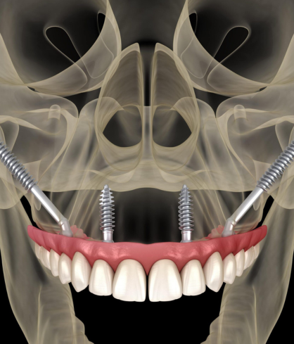 implants-for-less-no-bone-cases