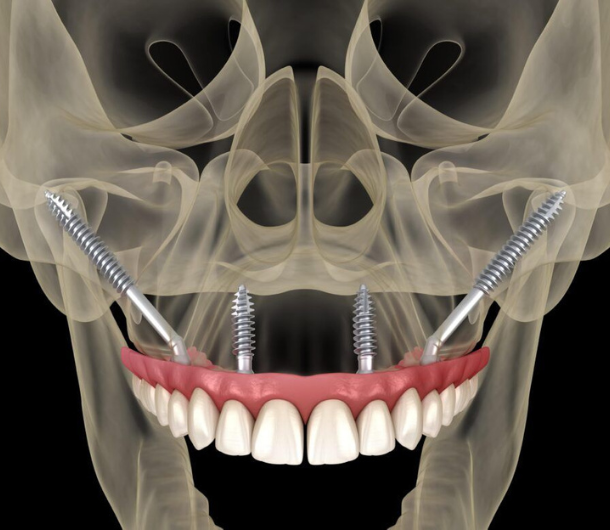 _upper jaw