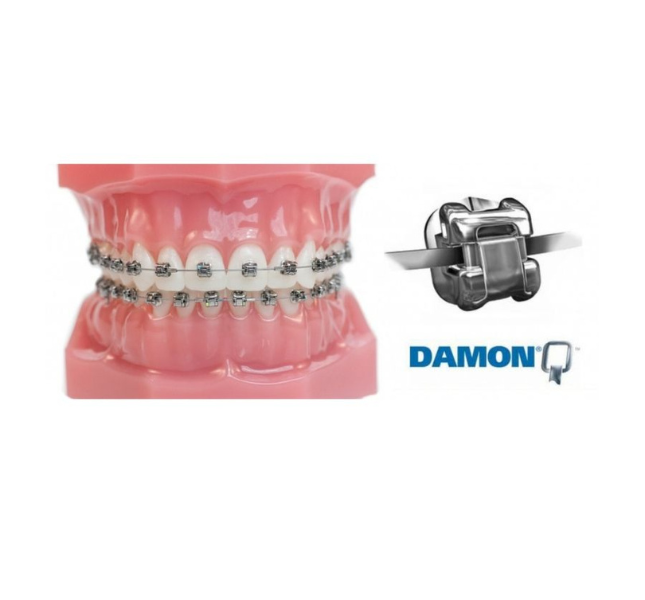 Benefits of Self-Ligating Braces (Damon Braces)