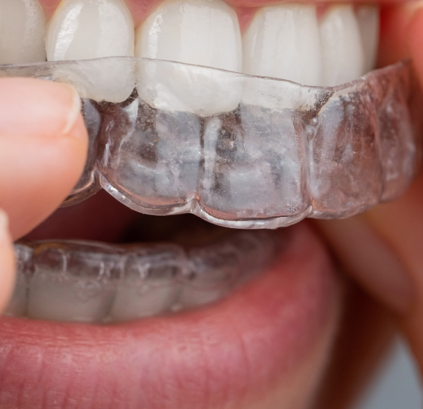 Clear Aligners