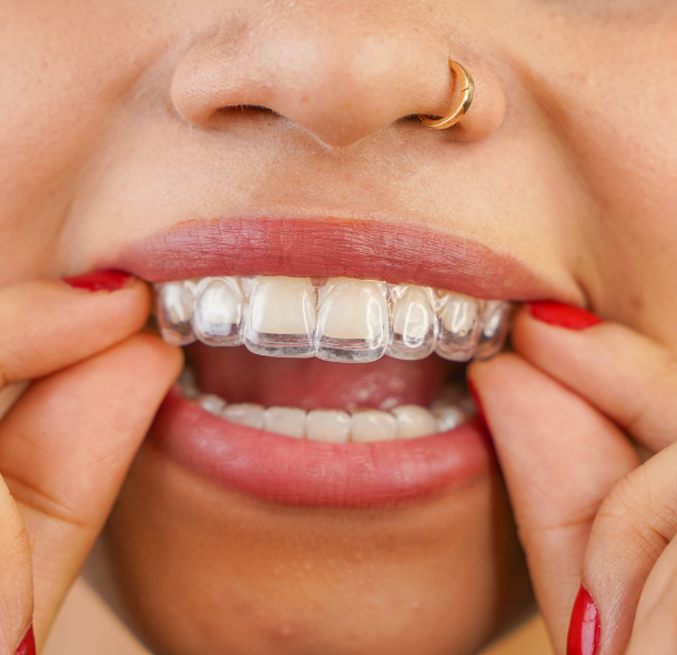 Clear Aligners