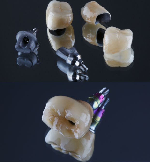 Dental-Crowns-Bridges-1-1