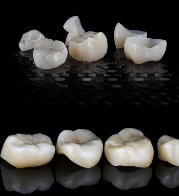Dental Crowns & Bridges (4)