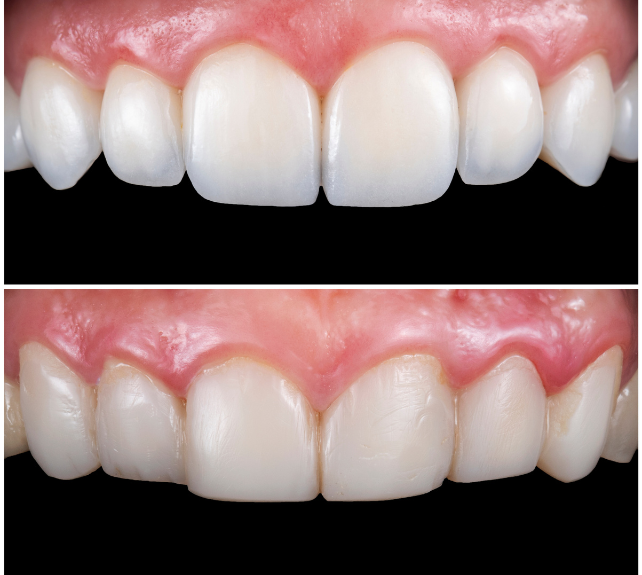 Porcelain Veneers,Composite Veneers
