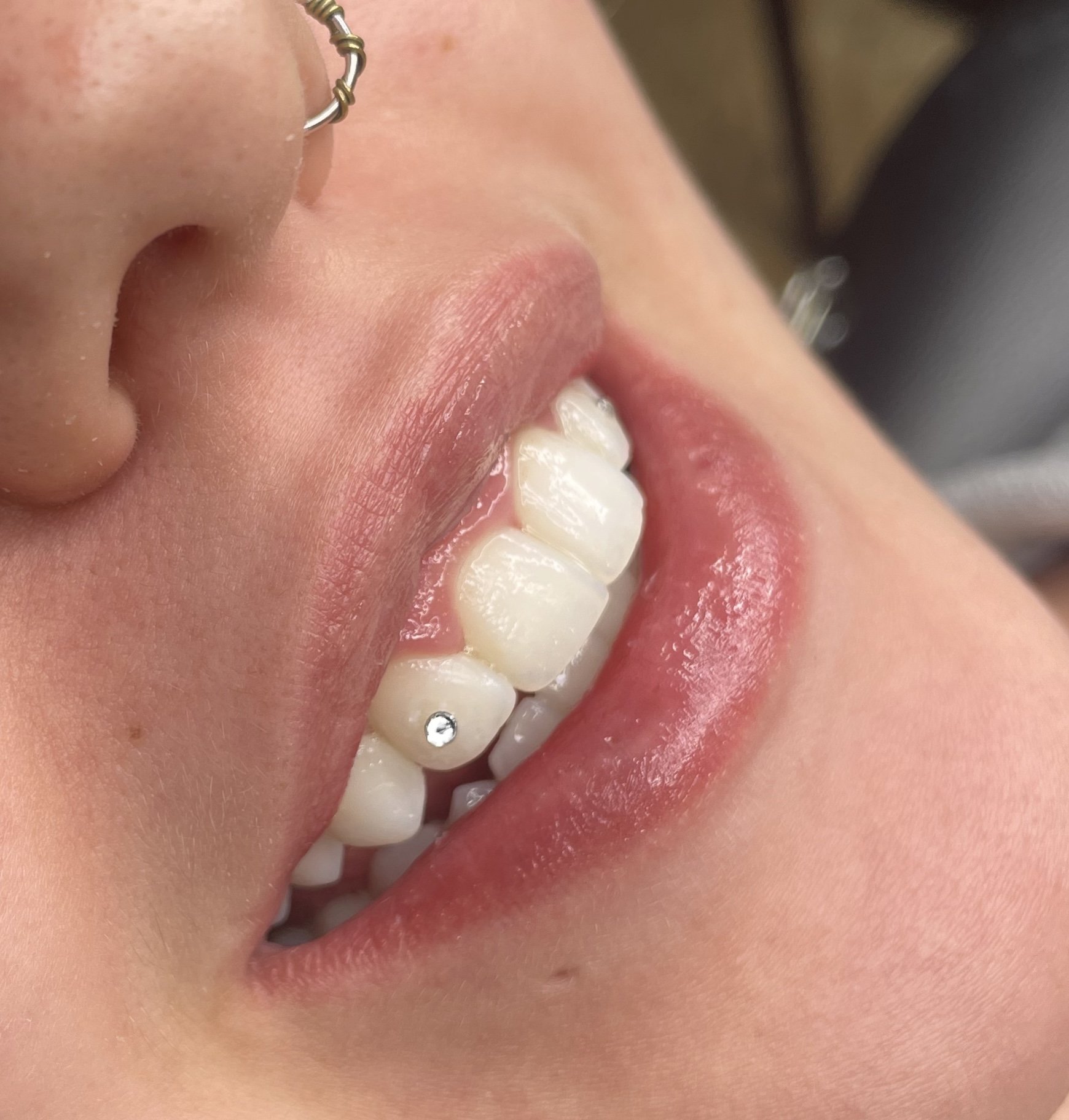 Diamond Placement(3)