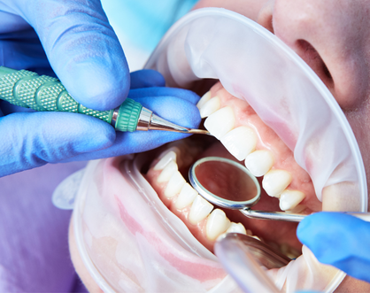 Treatment for Inadequate Mouth Opening