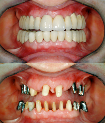 Full Mouth Rehabilitation