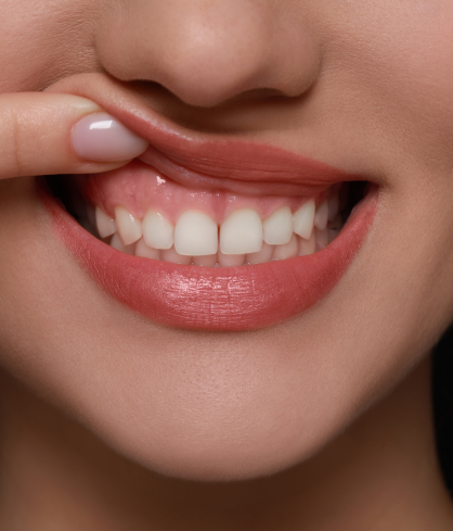 Gum Contouring