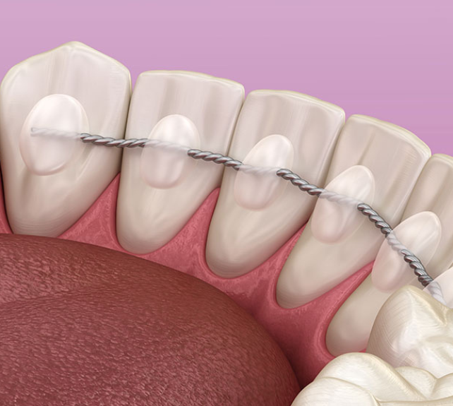 _Fixed Retainers (3)