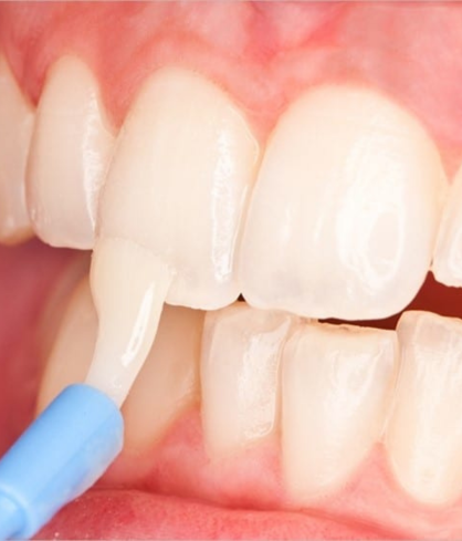 Fluoride Treatment