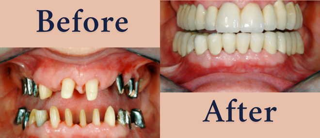 Full Mouth Rehabilitation