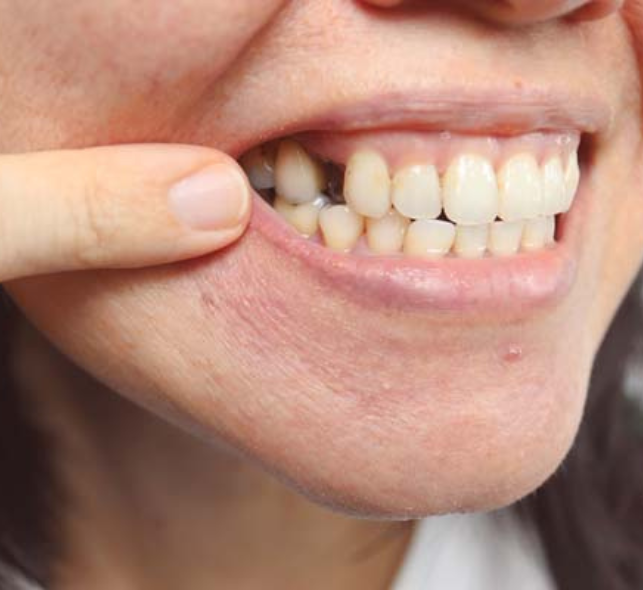 Full Mouth Rehabilitation (missing teeth)