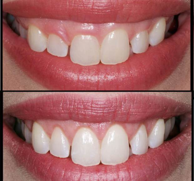 Reshaping uneven gum lines