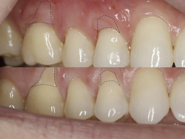 Gum Grafting