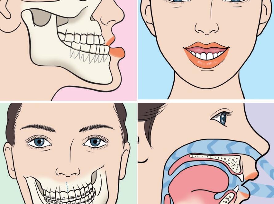 Jaw Surgery
