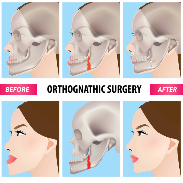 Jaw Surgery Needed
