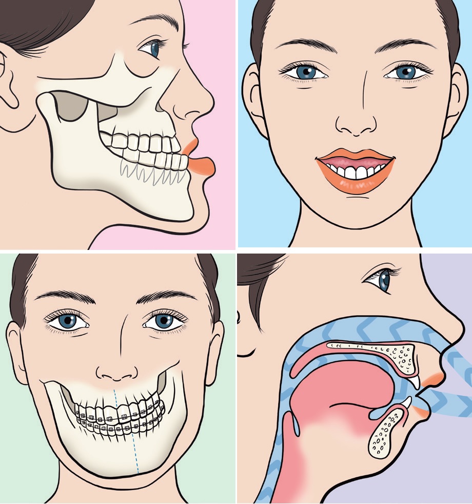 Jaw Surgery