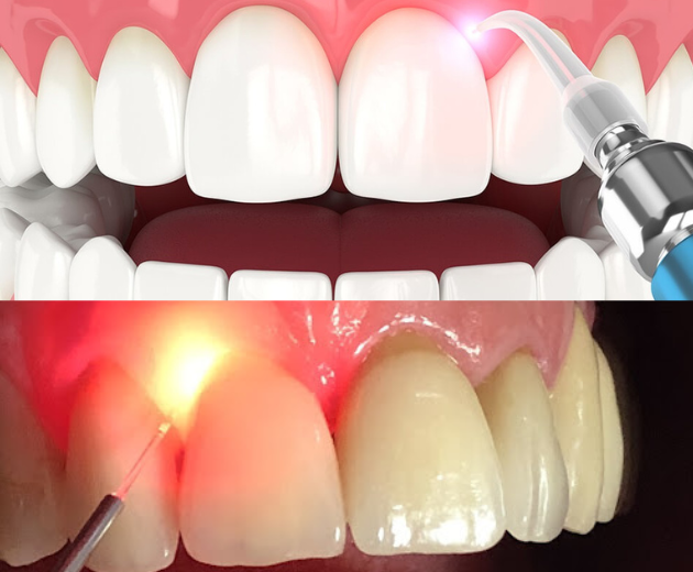 Laser Gum Treatment