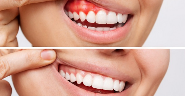 Laser Gum Treatment3