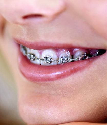 Metal & Ceramic Braces