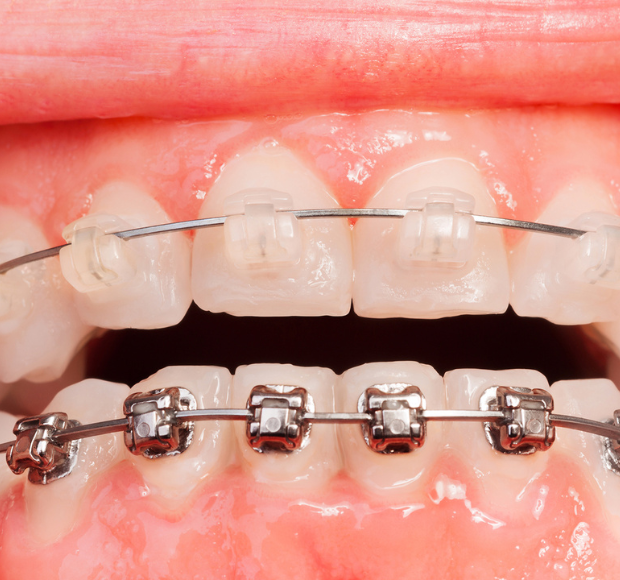 Metal & Ceramic Braces