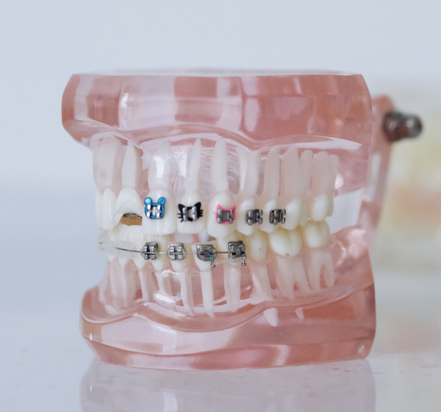Metal & Ceramic Braces