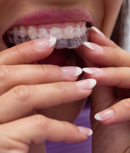 Oraguard Aligners