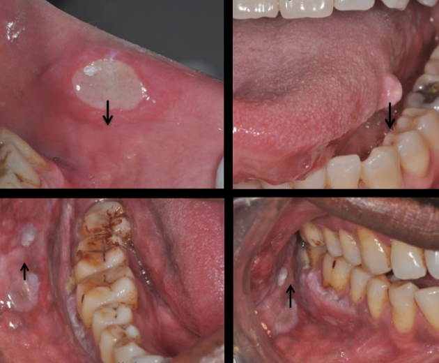 Oral Cancer Screening (4)