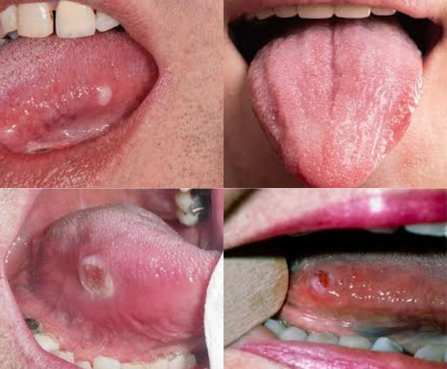 Oral Cancer Screening (5)