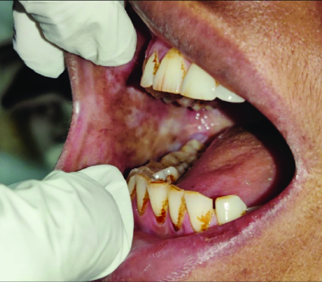 Oral Submucous Fibrosis