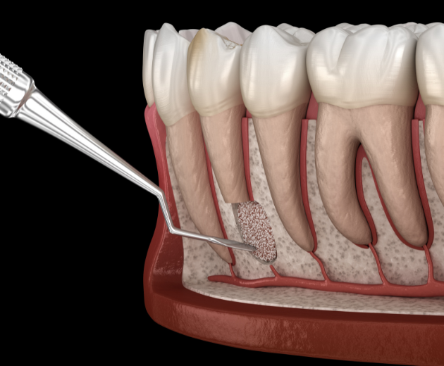 Periodontal Surgery2