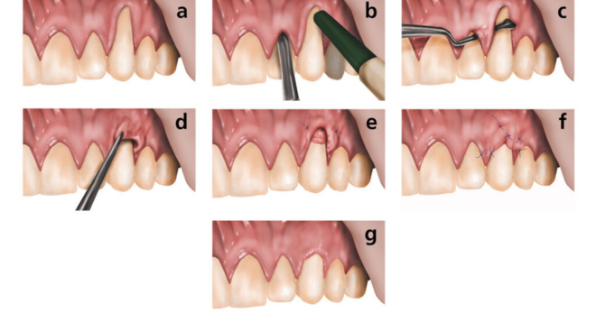 Periodontal Surgery