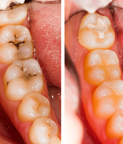 Pit & Fissure Sealants for Kids