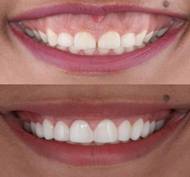Reshaping uneven gum lines