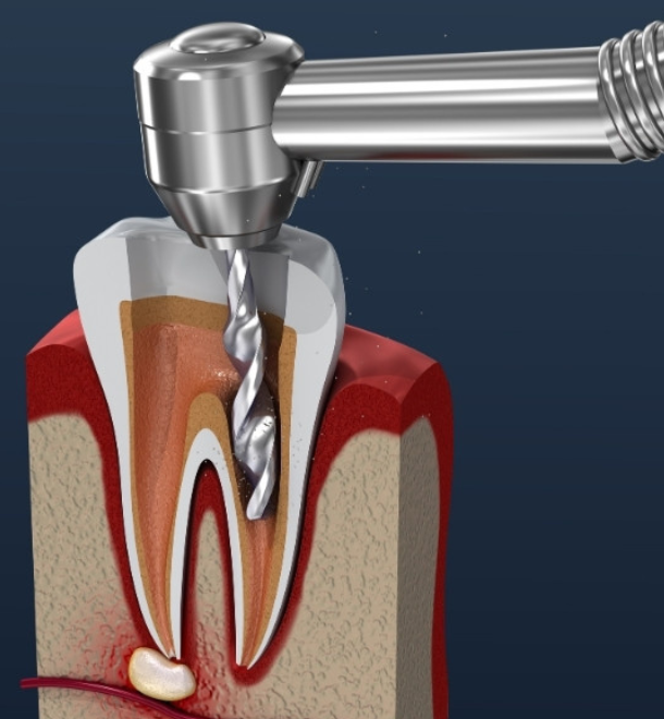 _Robo RCT (Single Sitting Root Canal) (1)