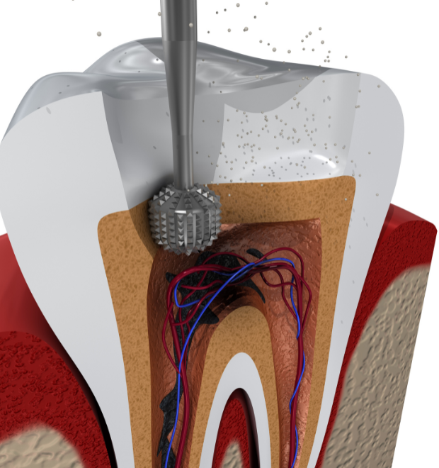 _Robo RCT (Single Sitting Root Canal) (3)