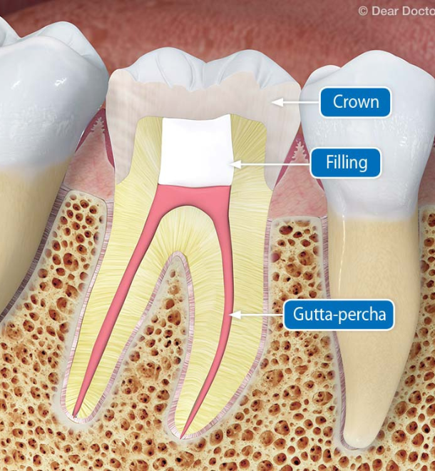 Root Canal Treatment (1)