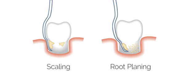 Root Planing2