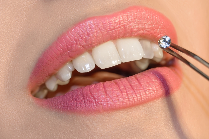 diamond placement in tooth Safe Bonding Process