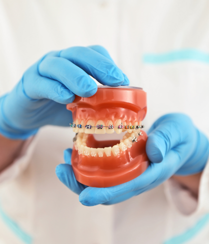 Self-Ligating Braces