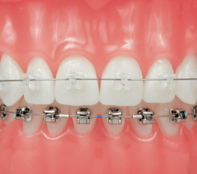 modern bracket system