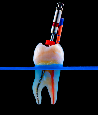 Single Sitting Root Canal