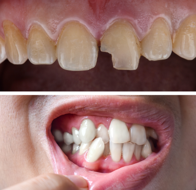 Teeth Whitening (Bleaching) (1)
