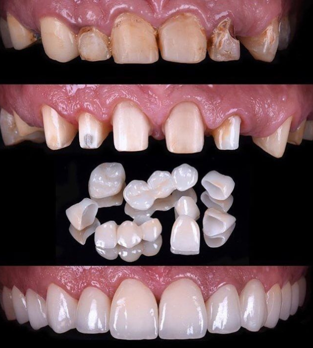 Full Mouth Rehabilitation