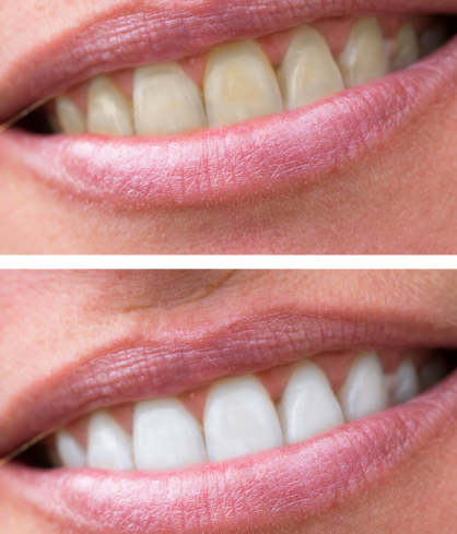 Teeth Whitening
